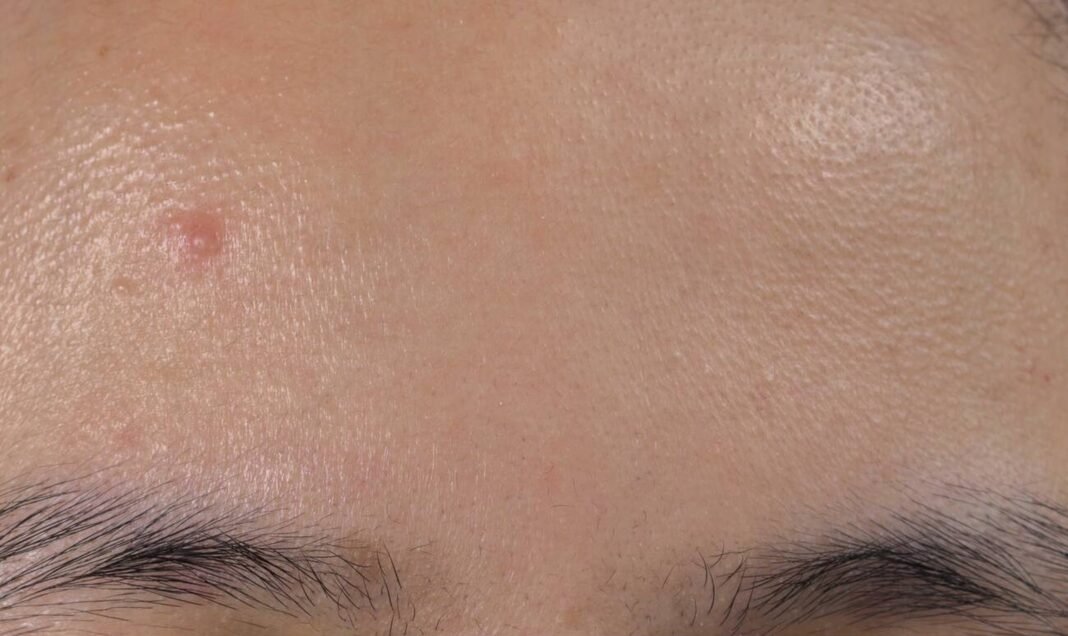 bump on eyebrow